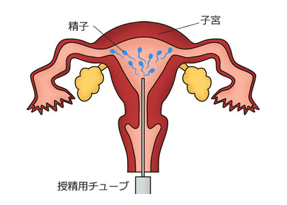 人工授精