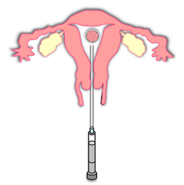 精子を卵子に注入する