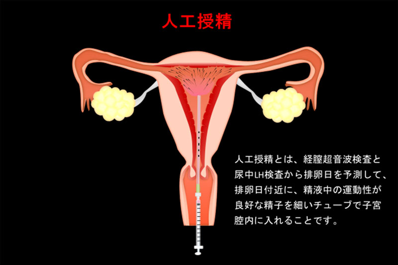 人工授精