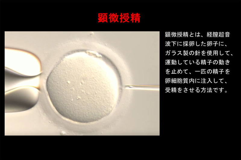 顕微授精（ICSI）