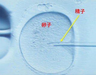 顕微授精