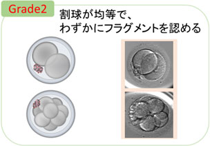 Grade2 割球が均等、わずかにフラグメントを認める