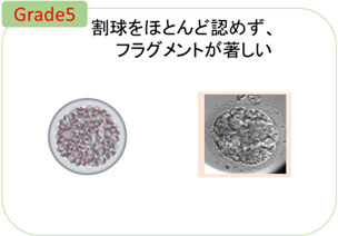 Grade5 割球をほとんど認めず、フラグメントが著しい